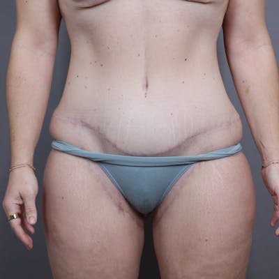 Abdominoplasty / Tummy Tuck Before & After Gallery - Patient 257565 - Image 2