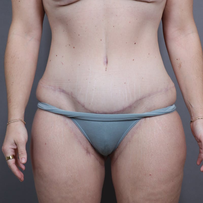 Abdominoplasty / Tummy Tuck Before & After Gallery - Patient 257565 - Image 2