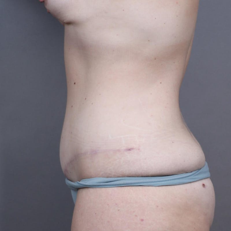 Abdominoplasty / Tummy Tuck Before & After Gallery - Patient 257565 - Image 4