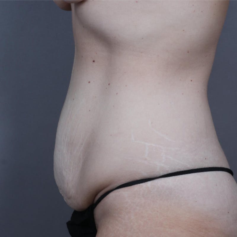 Abdominoplasty / Tummy Tuck Before & After Gallery - Patient 257565 - Image 3