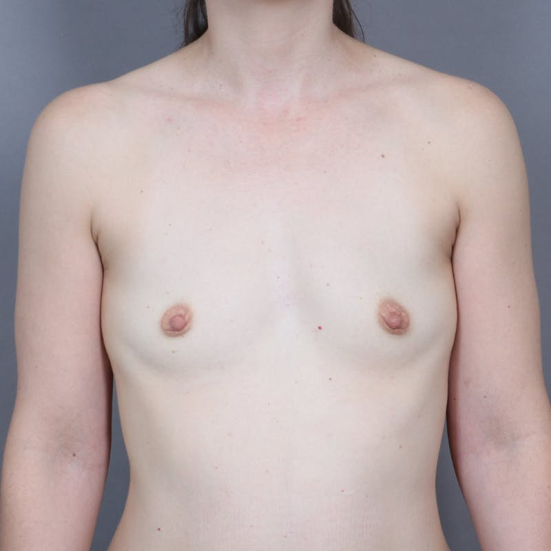 Breast Augmentation Before & After Gallery - Patient 253791 - Image 1