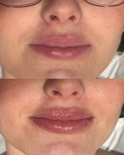 Lip Filler Before & After Gallery - Patient 277289 - Image 1