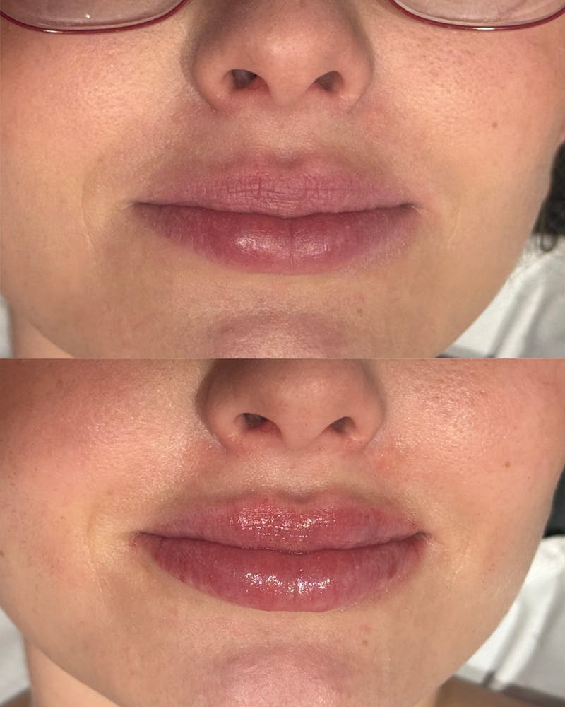 Lip Filler Before & After Gallery - Patient 277289 - Image 1