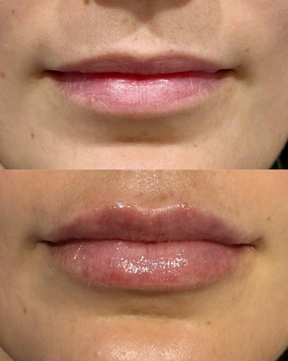 Lip Filler Before & After Gallery - Patient 180638 - Image 1