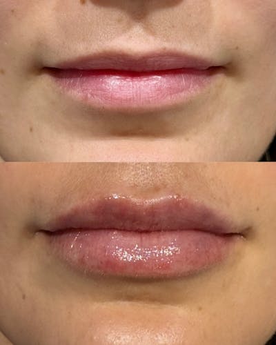 Lip Filler Before & After Gallery - Patient 180638 - Image 1