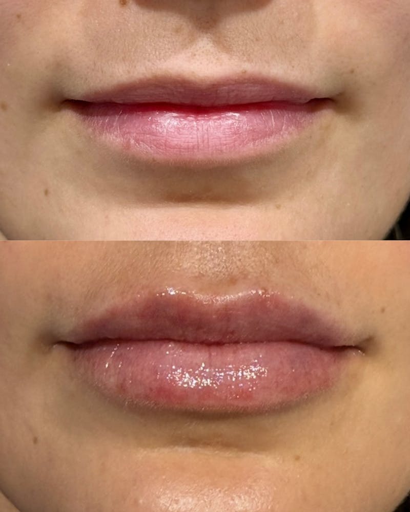 Lip Filler Before & After Gallery - Patient 180638 - Image 1