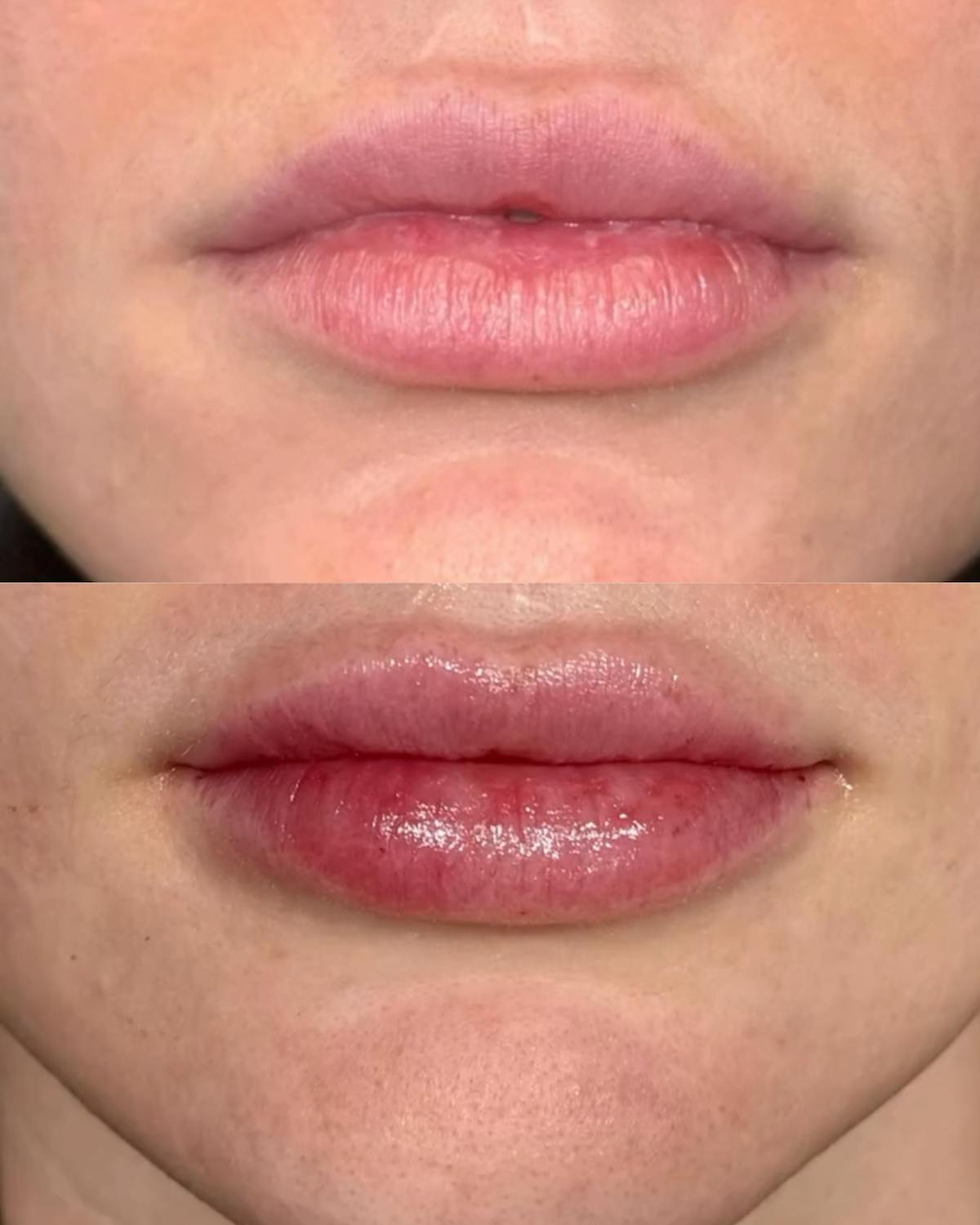 Lip Filler Before & After Gallery - Patient 585664 - Image 1