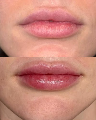 Lip Filler Before & After Gallery - Patient 585664 - Image 1