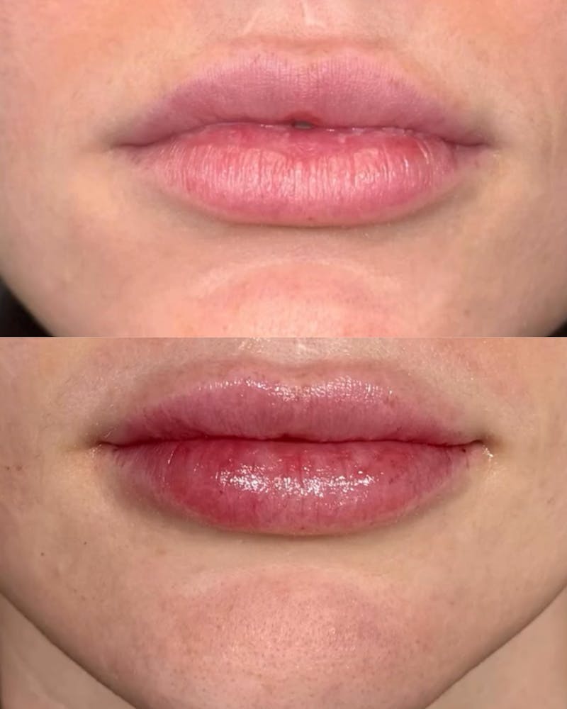 Lip Filler Before & After Gallery - Patient 585664 - Image 1