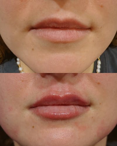 Lip Filler Before & After Gallery - Patient 326405 - Image 1