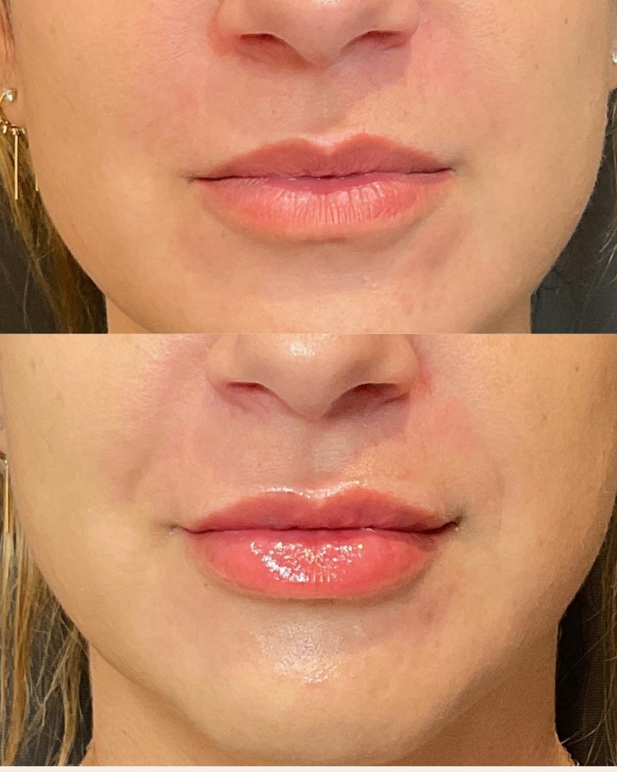 Lip Filler Before & After Gallery - Patient 249187 - Image 1