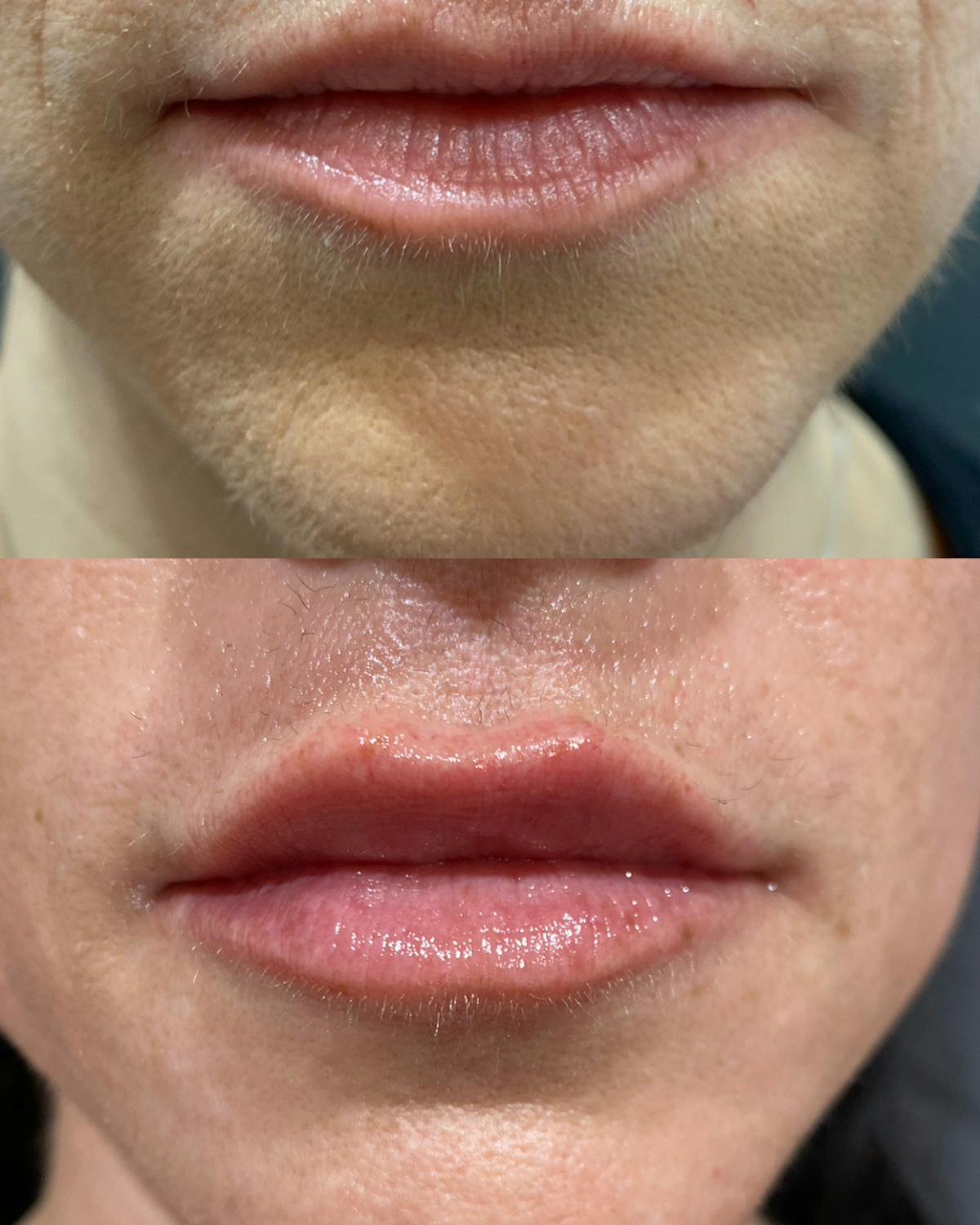 Lip Filler Before & After Gallery - Patient 241741 - Image 1