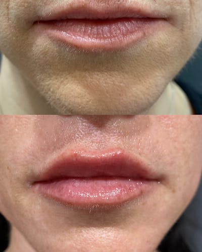 Lip Filler Before & After Gallery - Patient 241741 - Image 1