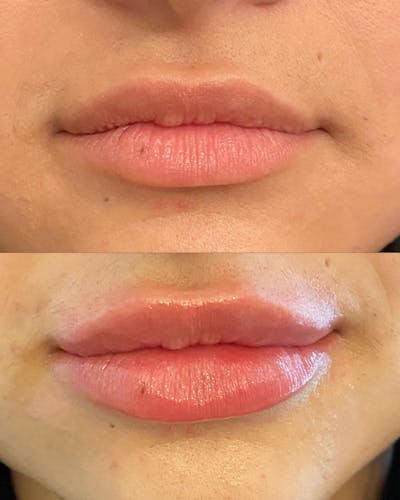 Lip Filler Before & After Gallery - Patient 679721 - Image 1