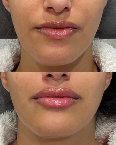Lip Filler Before & After Gallery - Patient 363311 - Image 1