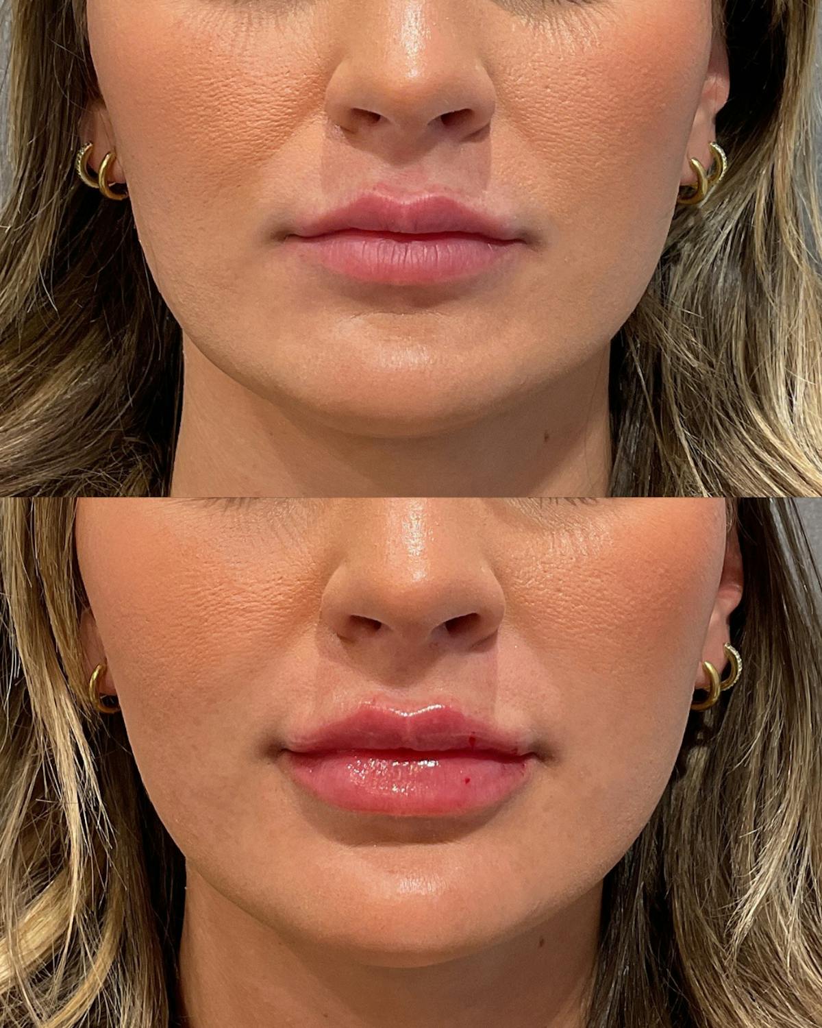 Lip Filler Before & After Gallery - Patient 121365 - Image 1