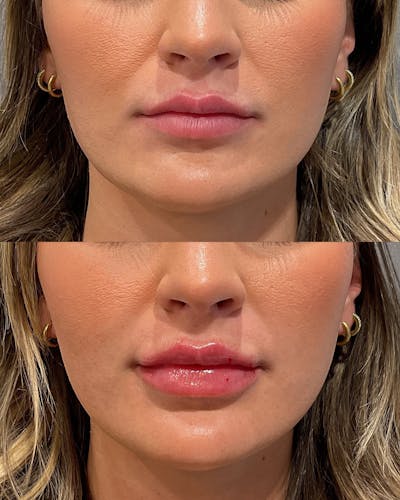Lip Filler Before & After Gallery - Patient 121365 - Image 1