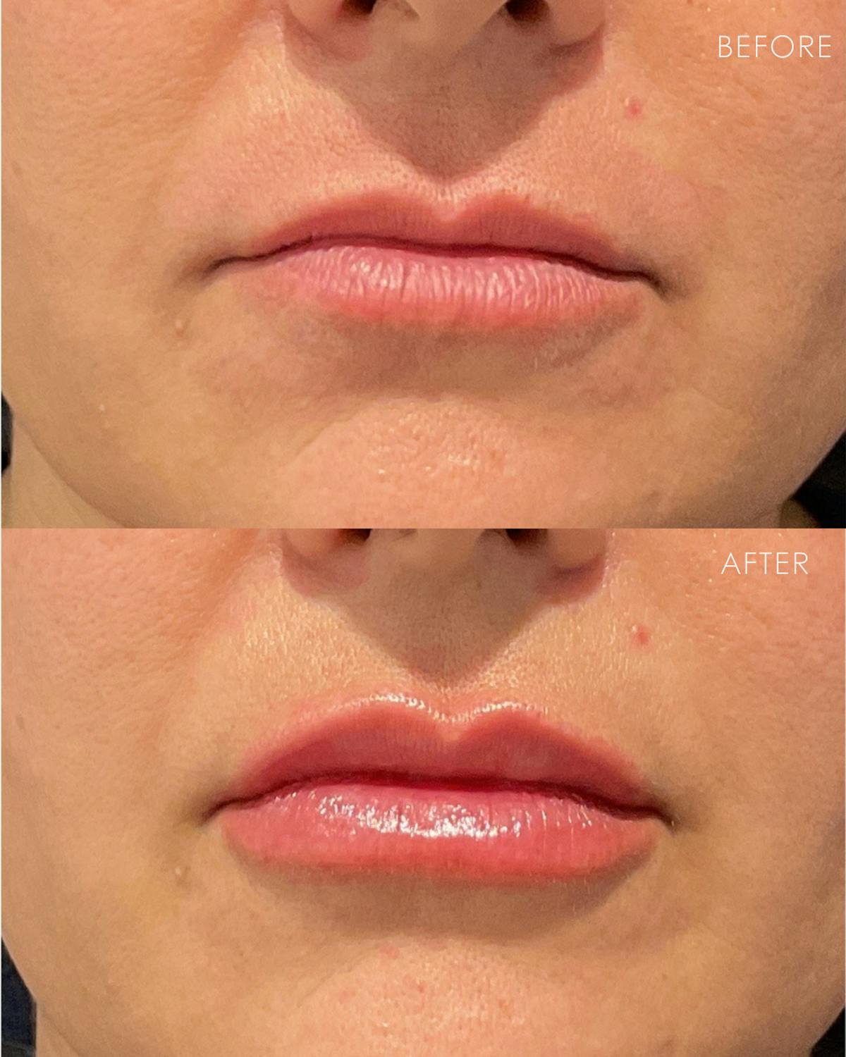 Lip Filler Before & After Gallery - Patient 187417 - Image 1