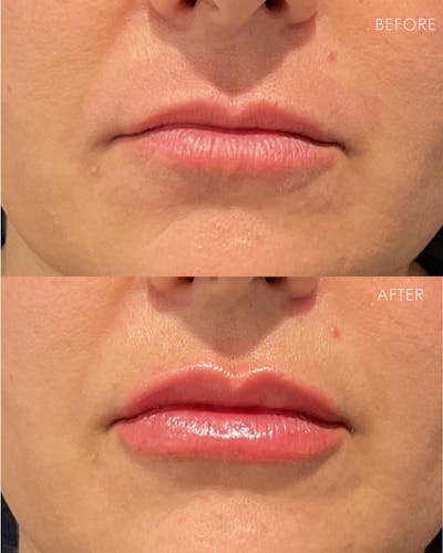 Lip Filler Before & After Gallery - Patient 187417 - Image 1