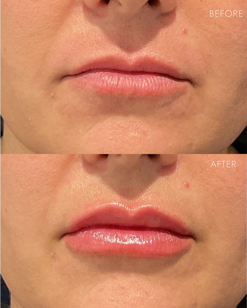 Lip Filler Before & After Gallery - Patient 187417 - Image 1