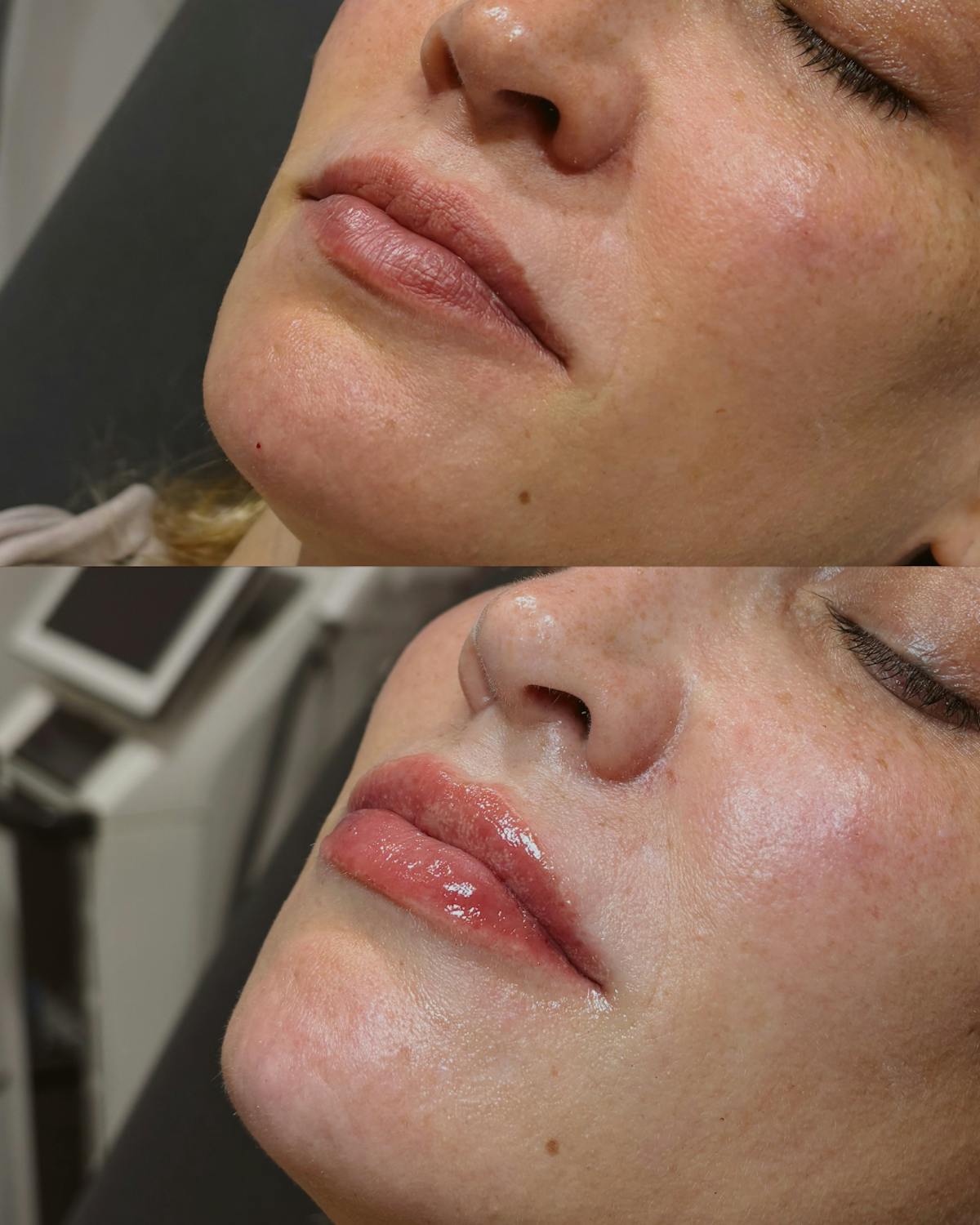Lip Filler Before & After Gallery - Patient 402566 - Image 1