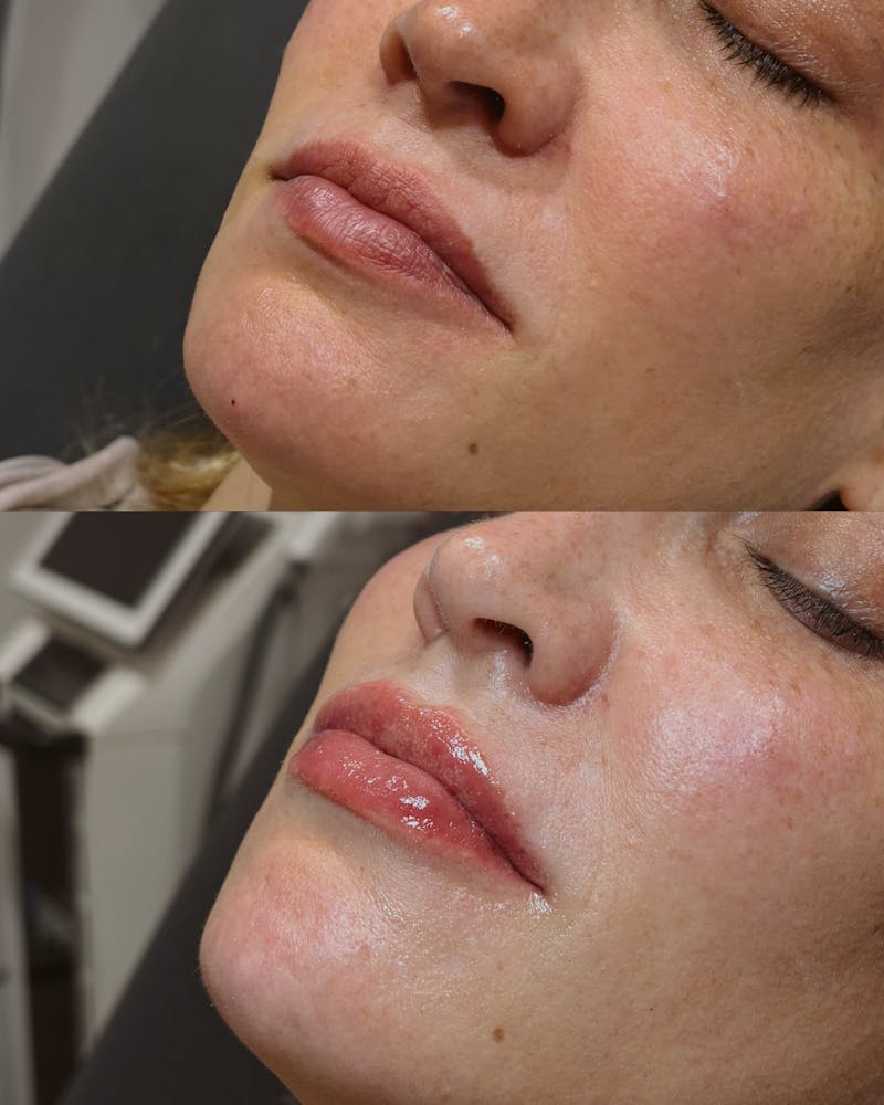 Lip Filler Before & After Gallery - Patient 402566 - Image 1
