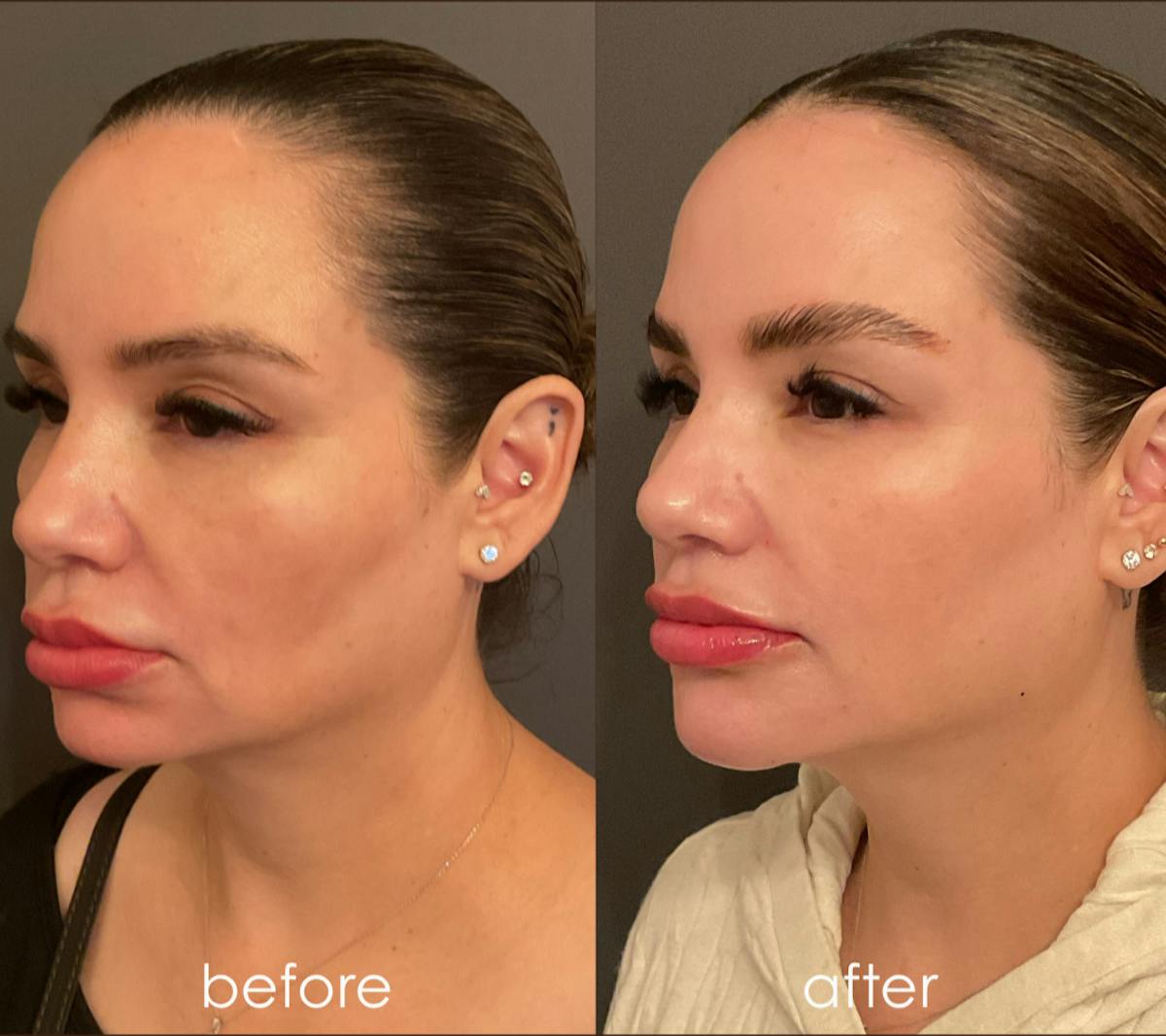 Facial Balancing Before & After Gallery - Patient 352293 - Image 1