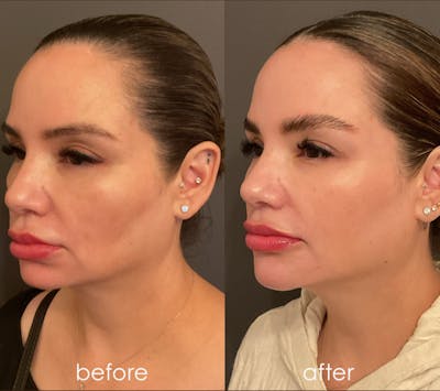 Facial Balancing Before & After Gallery - Patient 352293 - Image 1
