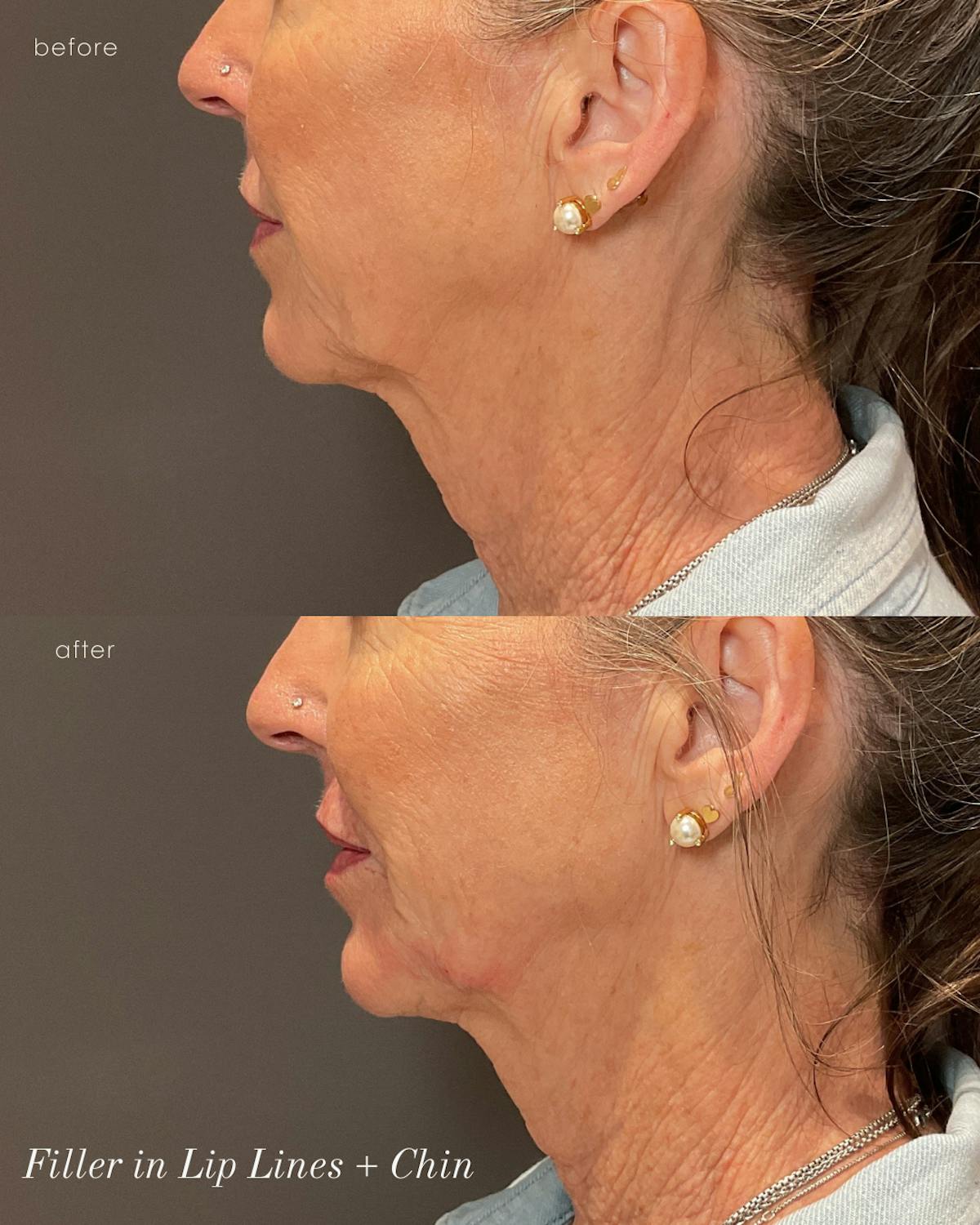 Facial Balancing Before & After Gallery - Patient 279123 - Image 1