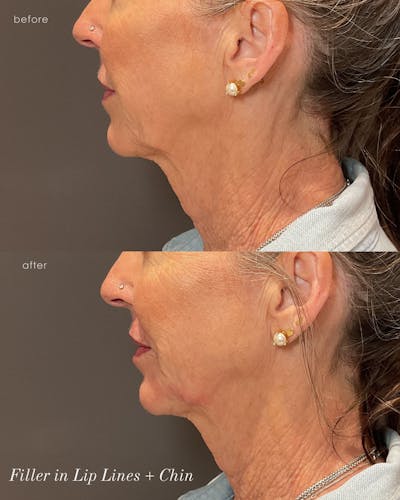 Facial Balancing Before & After Gallery - Patient 279123 - Image 1