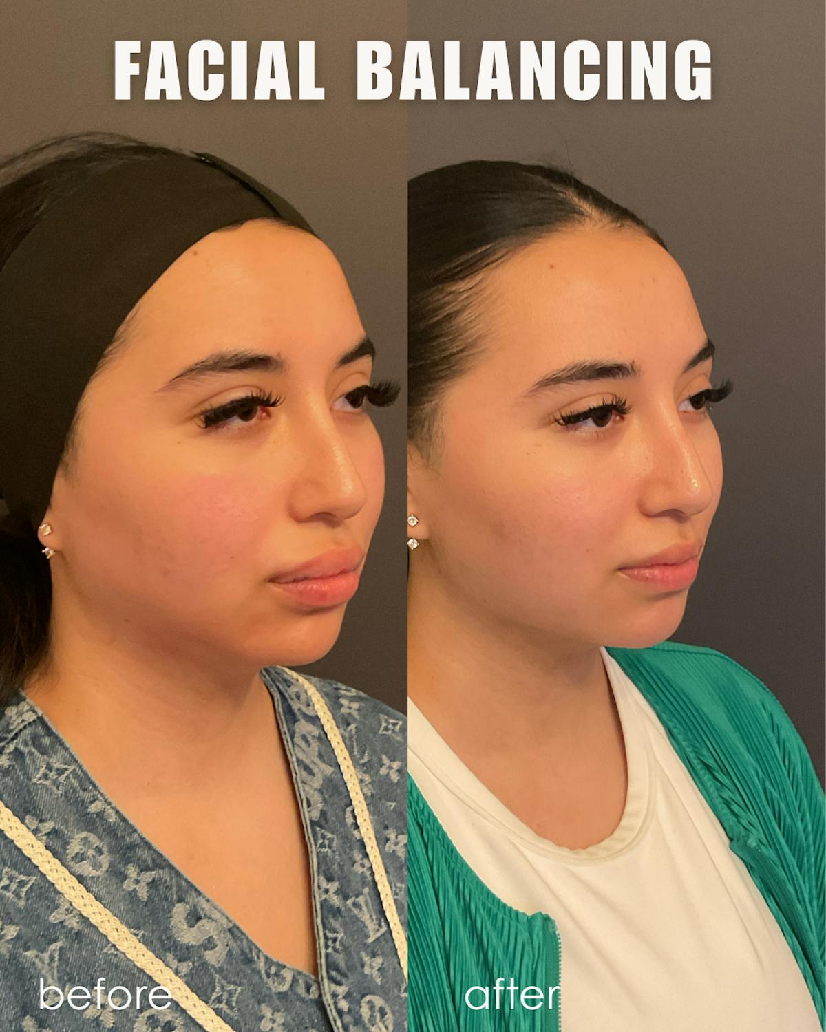 Facial Balancing Before & After Gallery - Patient 103181 - Image 2