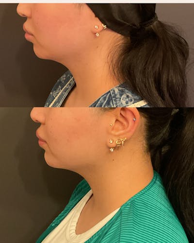 Facial Balancing Before & After Gallery - Patient 103181 - Image 1