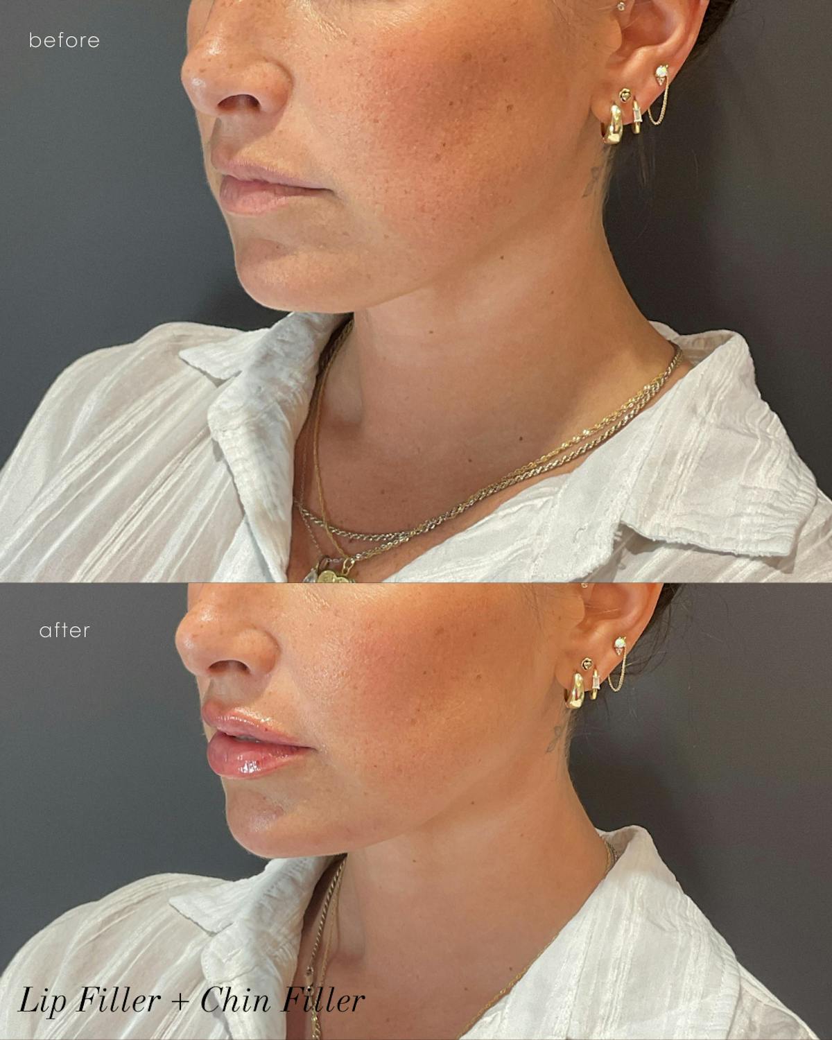 Facial Balancing Before & After Gallery - Patient 903831 - Image 1