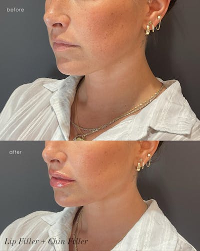 Facial Balancing Before & After Gallery - Patient 903831 - Image 1