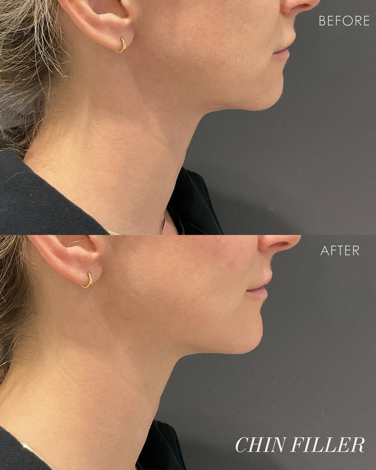 Facial Balancing Before & After Gallery - Patient 354703 - Image 1