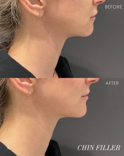 Facial Balancing Before & After Gallery - Patient 354703 - Image 1