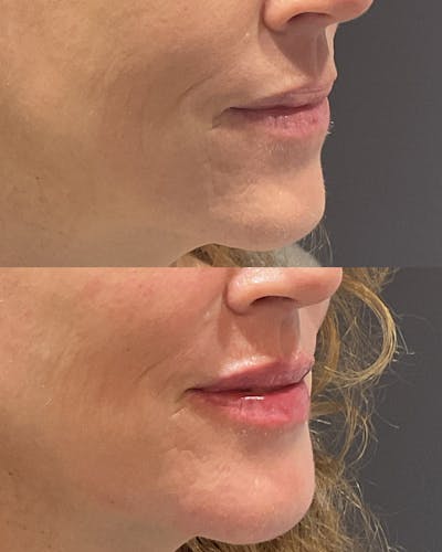 Facial Balancing Before & After Gallery - Patient 425749 - Image 1