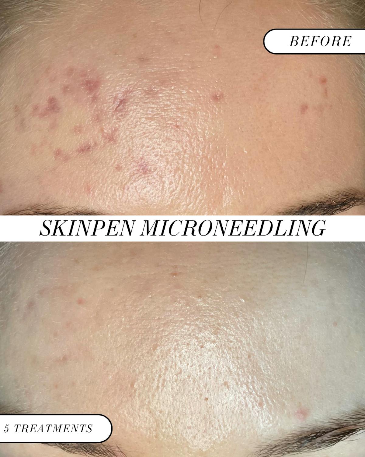 SkinPen Microneedling Before & After Gallery - Patient 679824 - Image 1