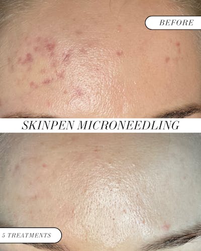 SkinPen Microneedling Before & After Gallery - Patient 679824 - Image 1