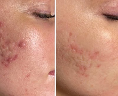 SkinPen Microneedling Before & After Gallery - Patient 241510 - Image 1
