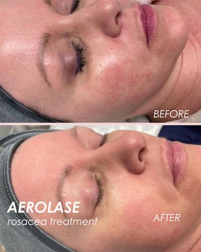 Aerolase Before & After Gallery - Patient 943971 - Image 1