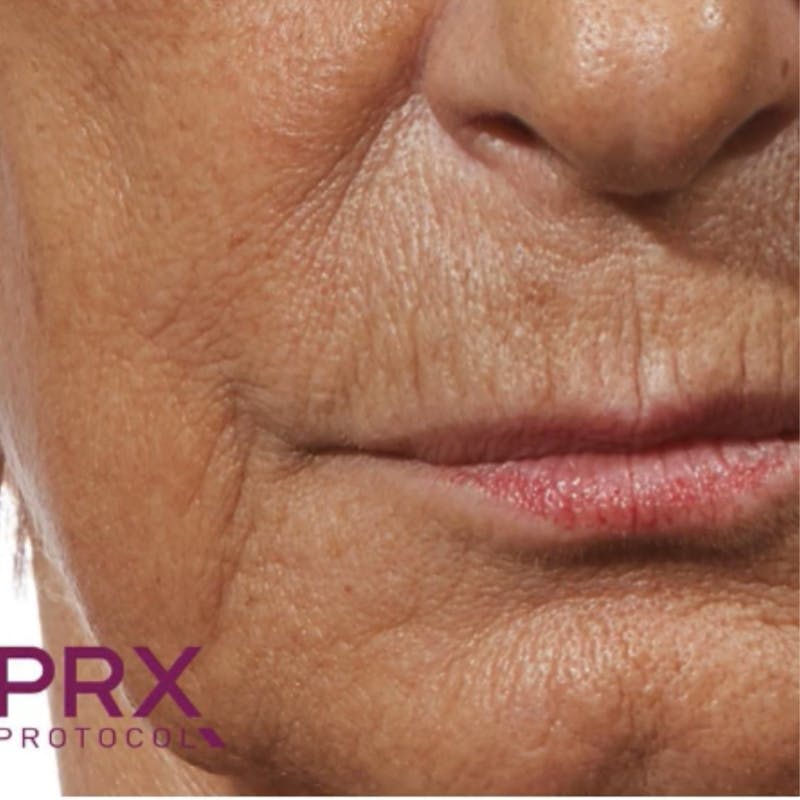 PRX DERM PERFEXION Before & After Gallery - Patient 234814 - Image 1