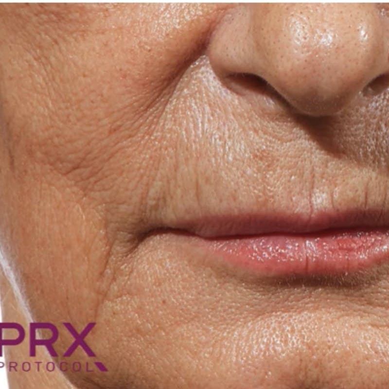 PRX DERM PERFEXION Before & After Gallery - Patient 234814 - Image 2