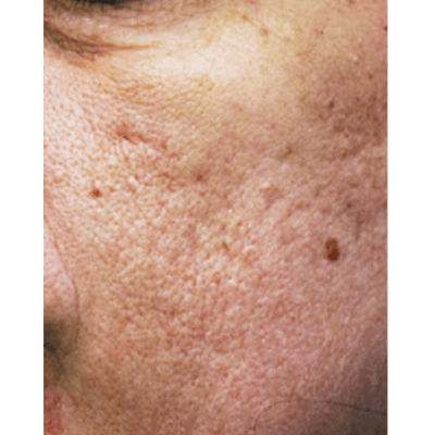 PRX DERM PERFEXION Before & After Gallery - Patient 151913 - Image 1