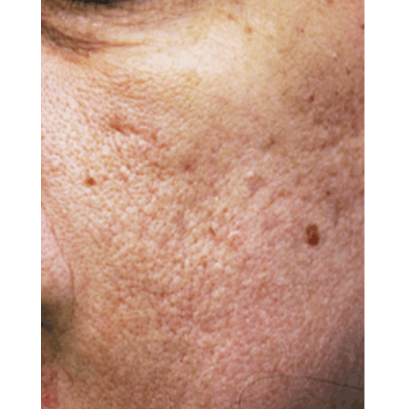 PRX DERM PERFEXION Before & After Gallery - Patient 151913 - Image 1