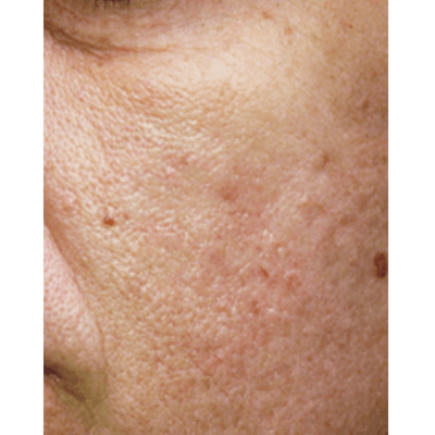 PRX DERM PERFEXION Before & After Gallery - Patient 151913 - Image 2