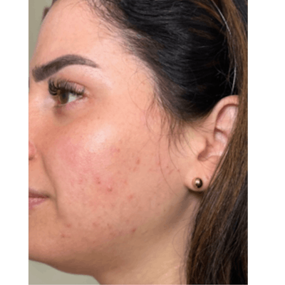 PRX DERM PERFEXION Before & After Gallery - Patient 279681 - Image 1