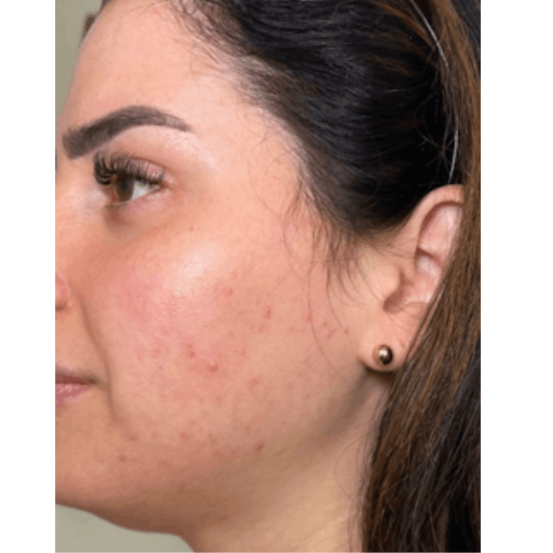 PRX DERM PERFEXION Before & After Gallery - Patient 279681 - Image 1