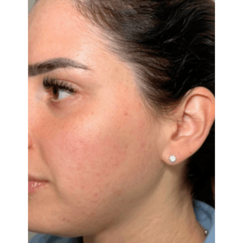 PRX DERM PERFEXION Before & After Gallery - Patient 279681 - Image 2