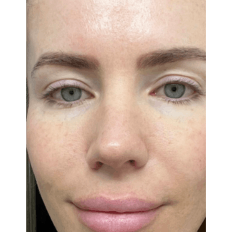 PRX DERM PERFEXION Before & After Gallery - Patient 490413 - Image 2